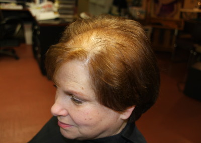 BEFORE - Hair Loss due to Female Pattern Baldness